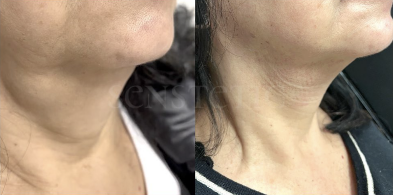 Senstetic-endolift 1