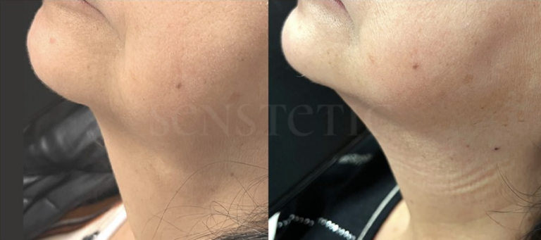 Senstetic-endolift 2