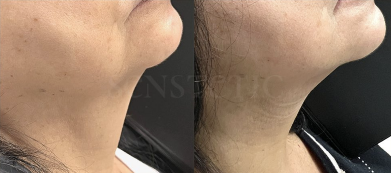 Senstetic-endolift 3