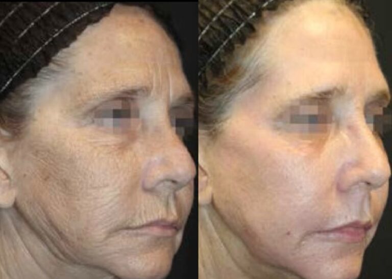 Cortesía del Dr. Jeffrey Hsu, MD, miembro de la academia estadounidense de dermatología FAAD