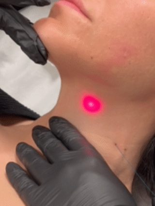 Endolift en Valencia en clínica Senstetic. Lifting sin cirugía