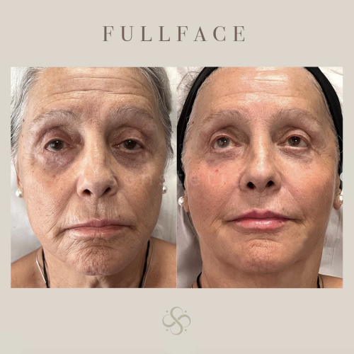fullface